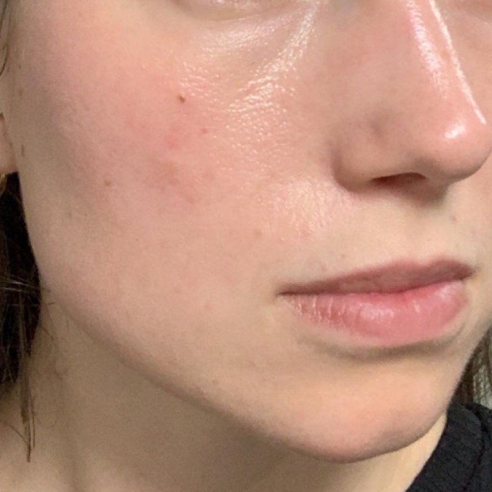 Orlando beauty microneedling after