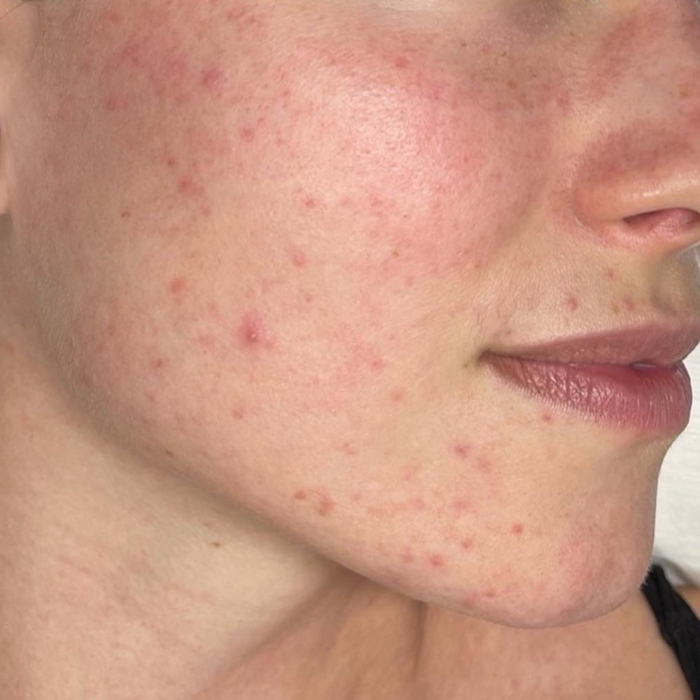 Orlando beauty microneedling after